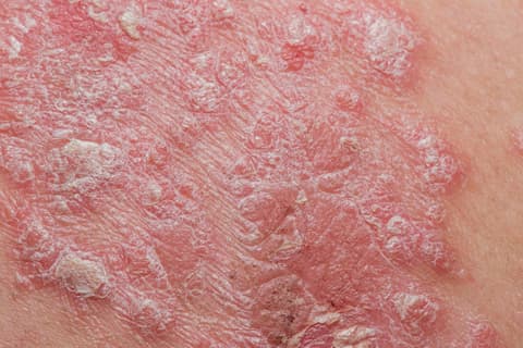 psoriasis