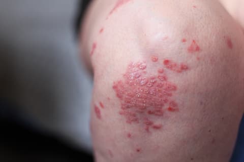 psoriasis causes