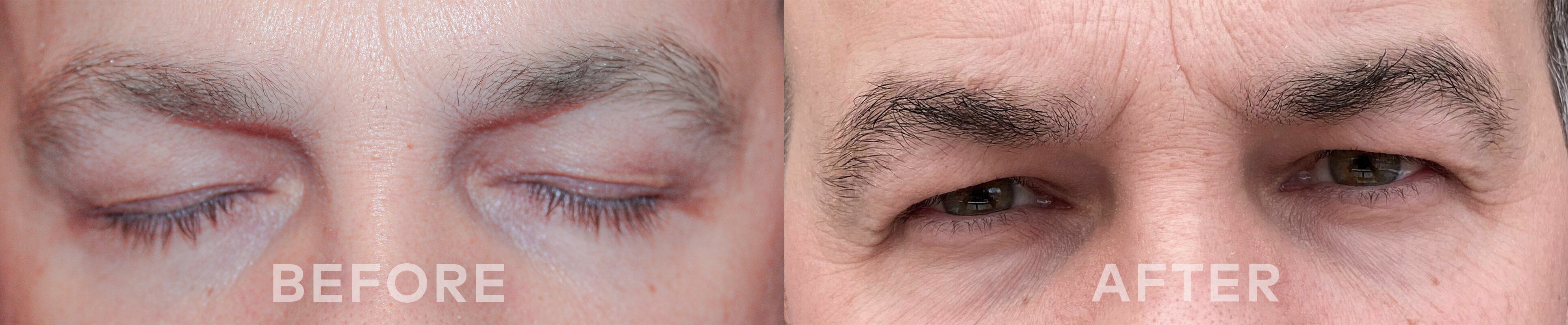 before and after using ADOREYES eyebrows growth serum