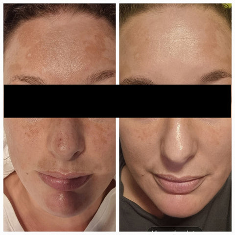 dramatic before and after skincare results