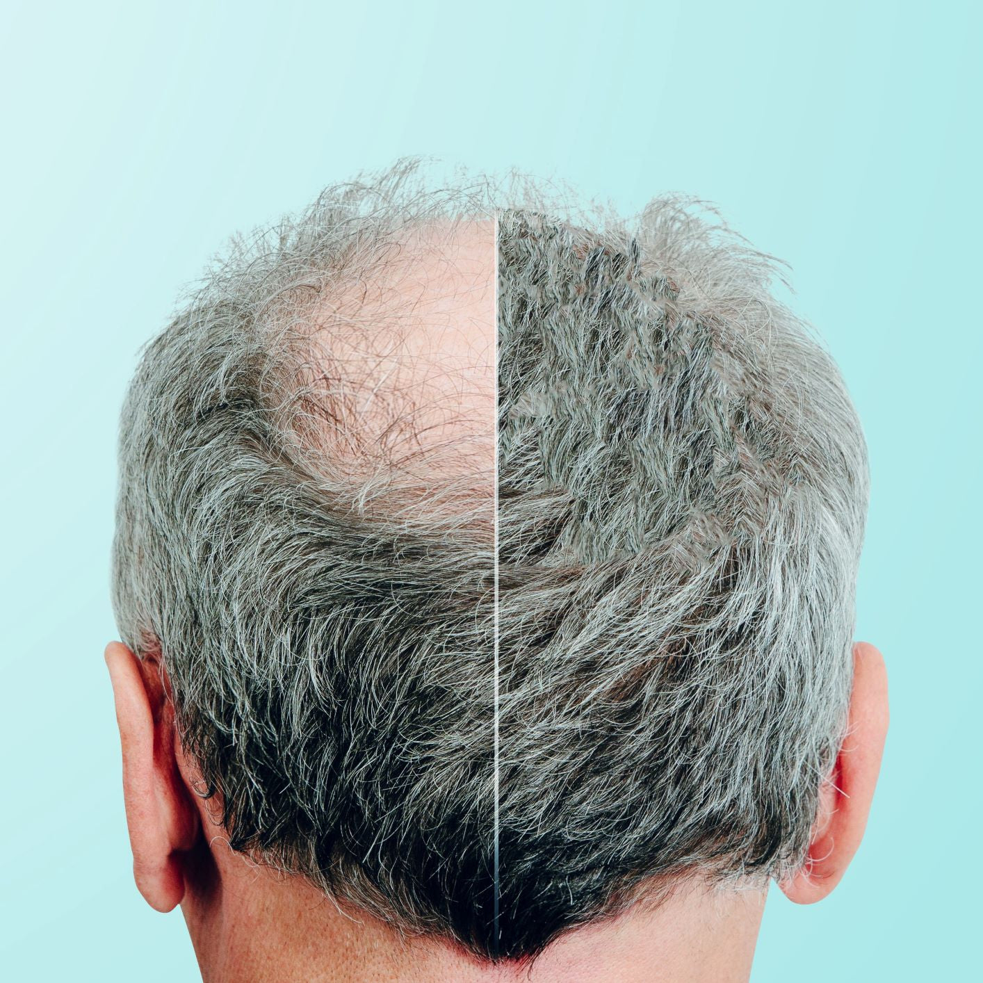 Finasteride Before and After Images
