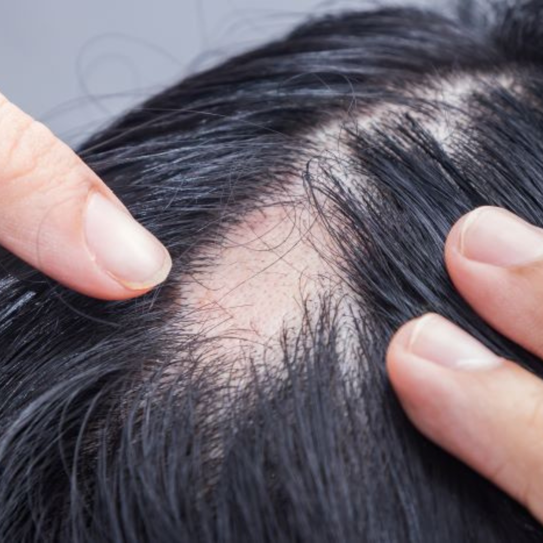 What Is Diffuse Alopecia Areata? Here’s Everything You Need To Know