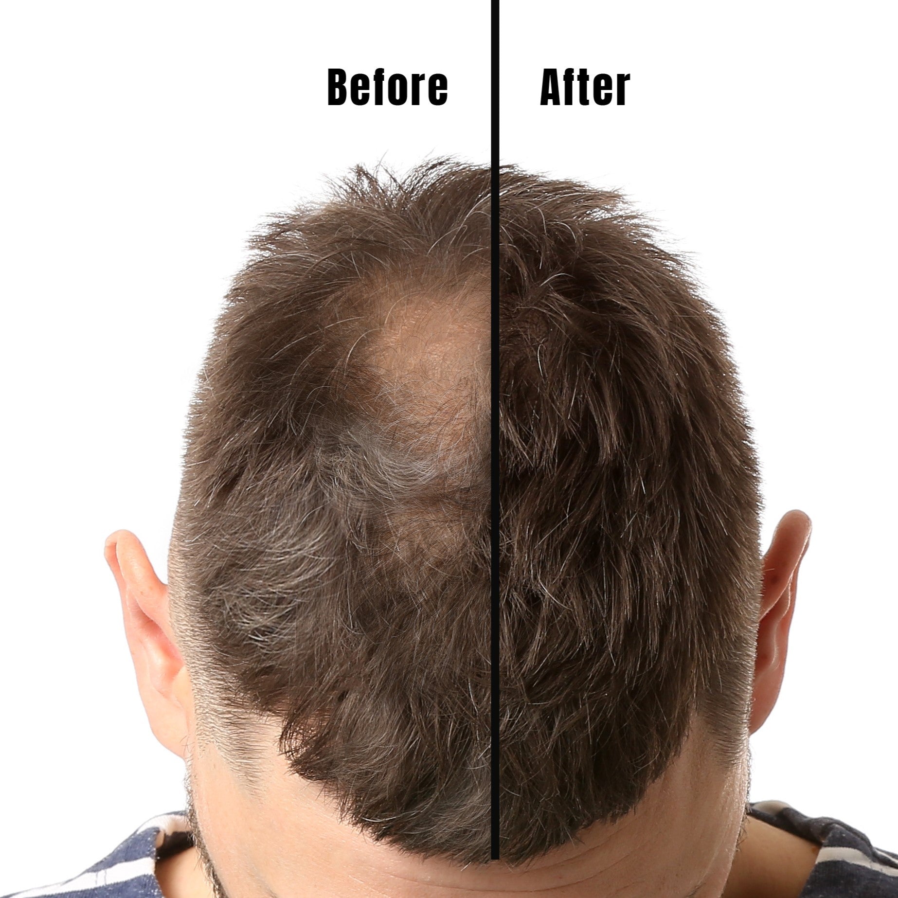 forråde Neuropati Muskuløs Results From Minoxidil: Before And After Pictures