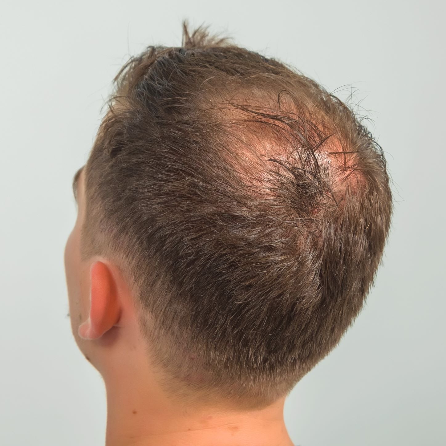 Finasteride Use by Young Men Not only for Baldness in the Crown    Donovan Hair Clinic
