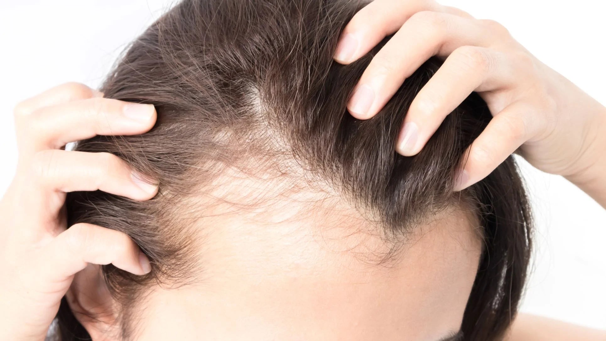 female pattern hair loss, lose hair