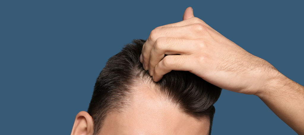 male pattern hair loss due to finasteride not working