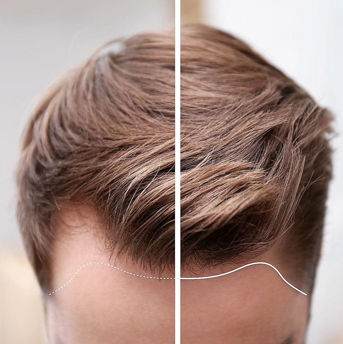 uneven hairline comparison