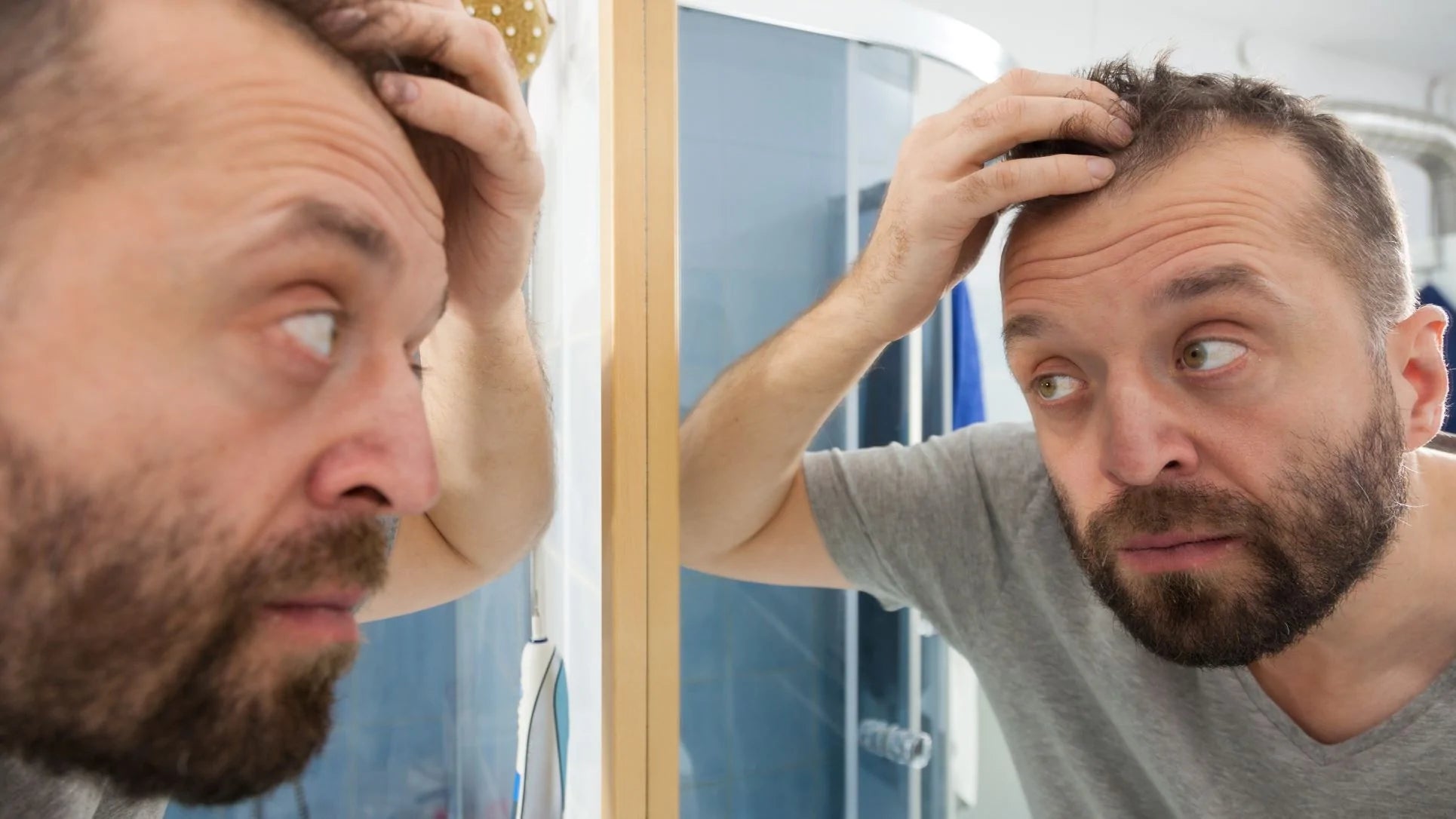 hair receding, hair loss treatment