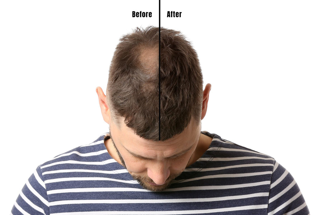 Finasteride Results Uncover the Truth About Hair Regrowth Success