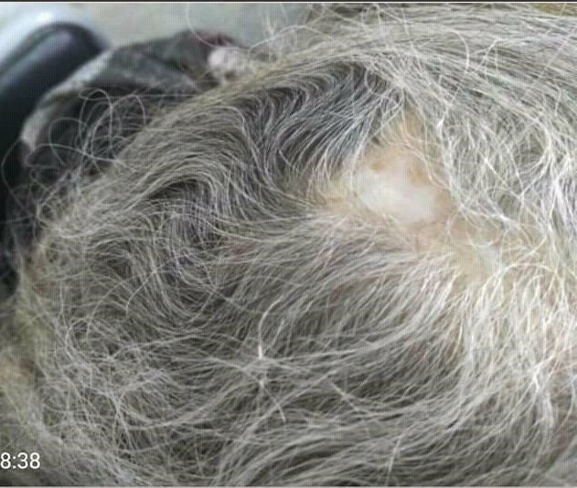 lupus hair loss on scalp