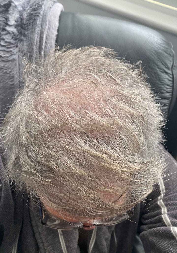 Gary after male pattern baldness treated