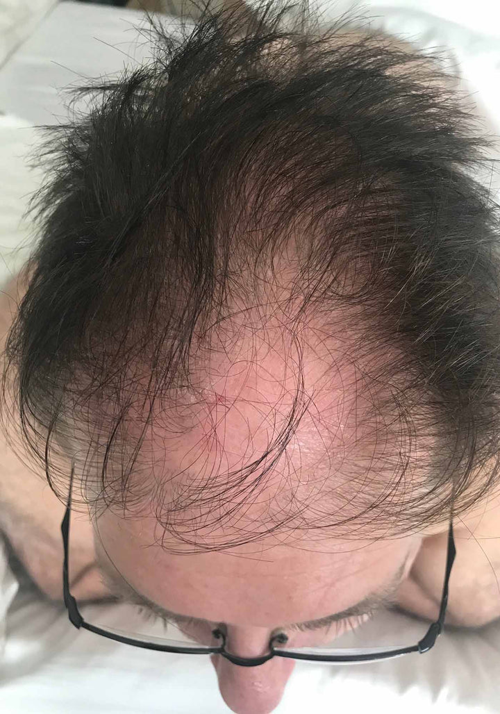 Gary male pattern hair loss treated