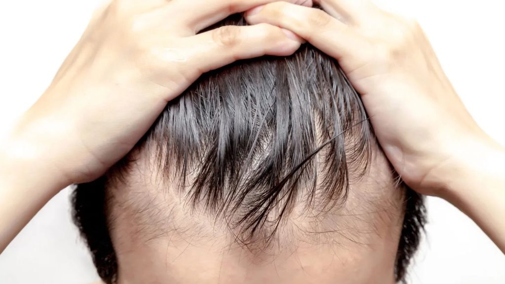 bosley hair transplant cost