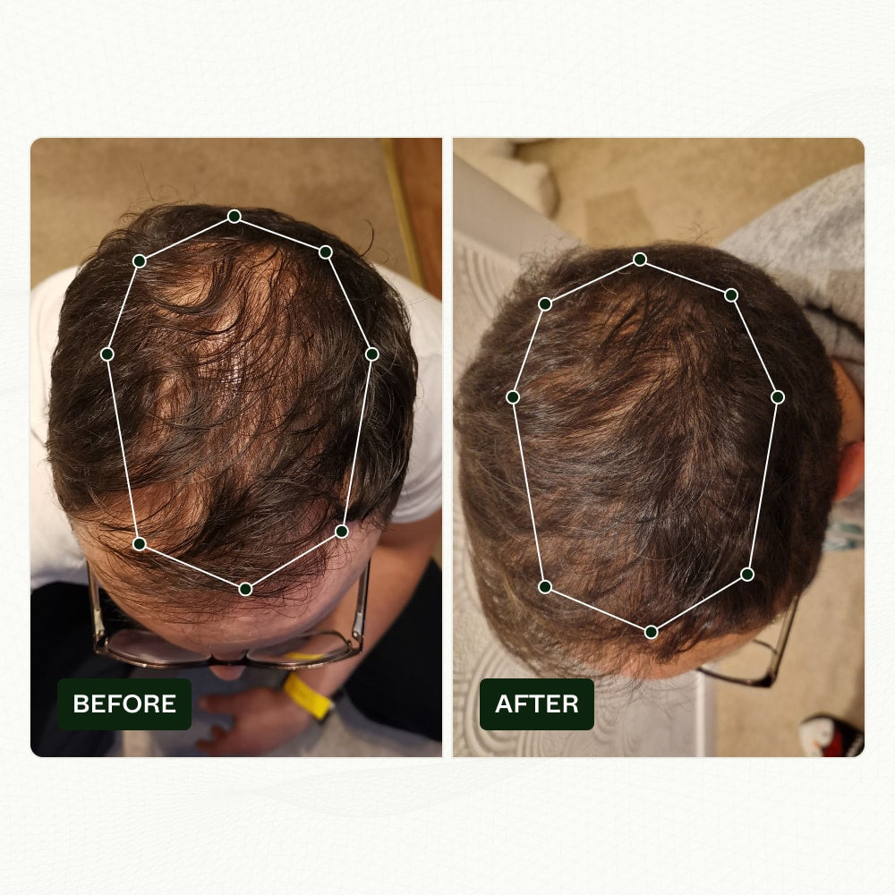 androgenetic alopecia before and after
