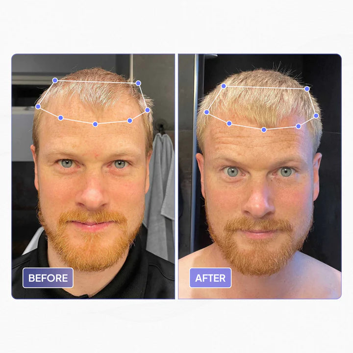 forehead reduction vs hair transplant alternative