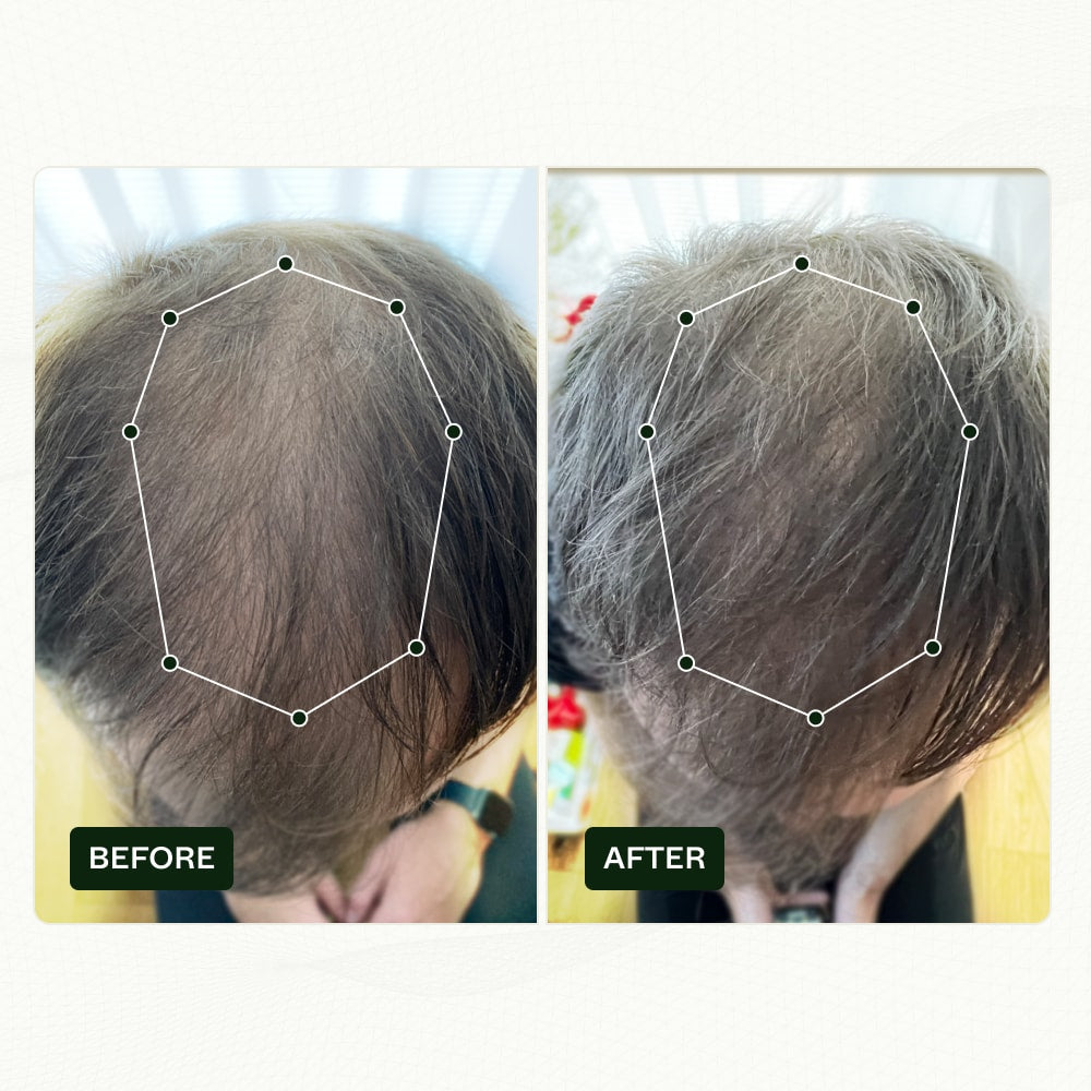 finasteride alternative before and after