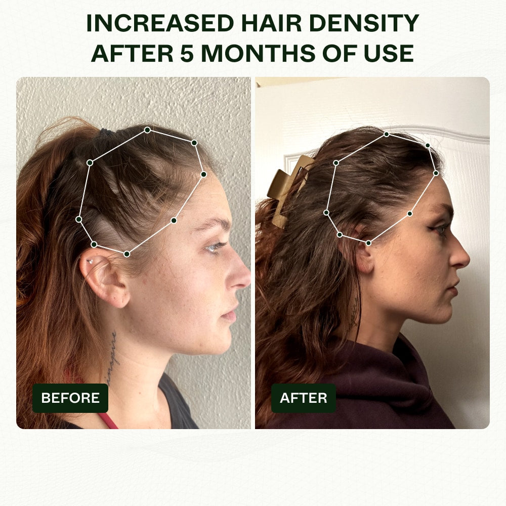 before and after best hair regrowth serum for women