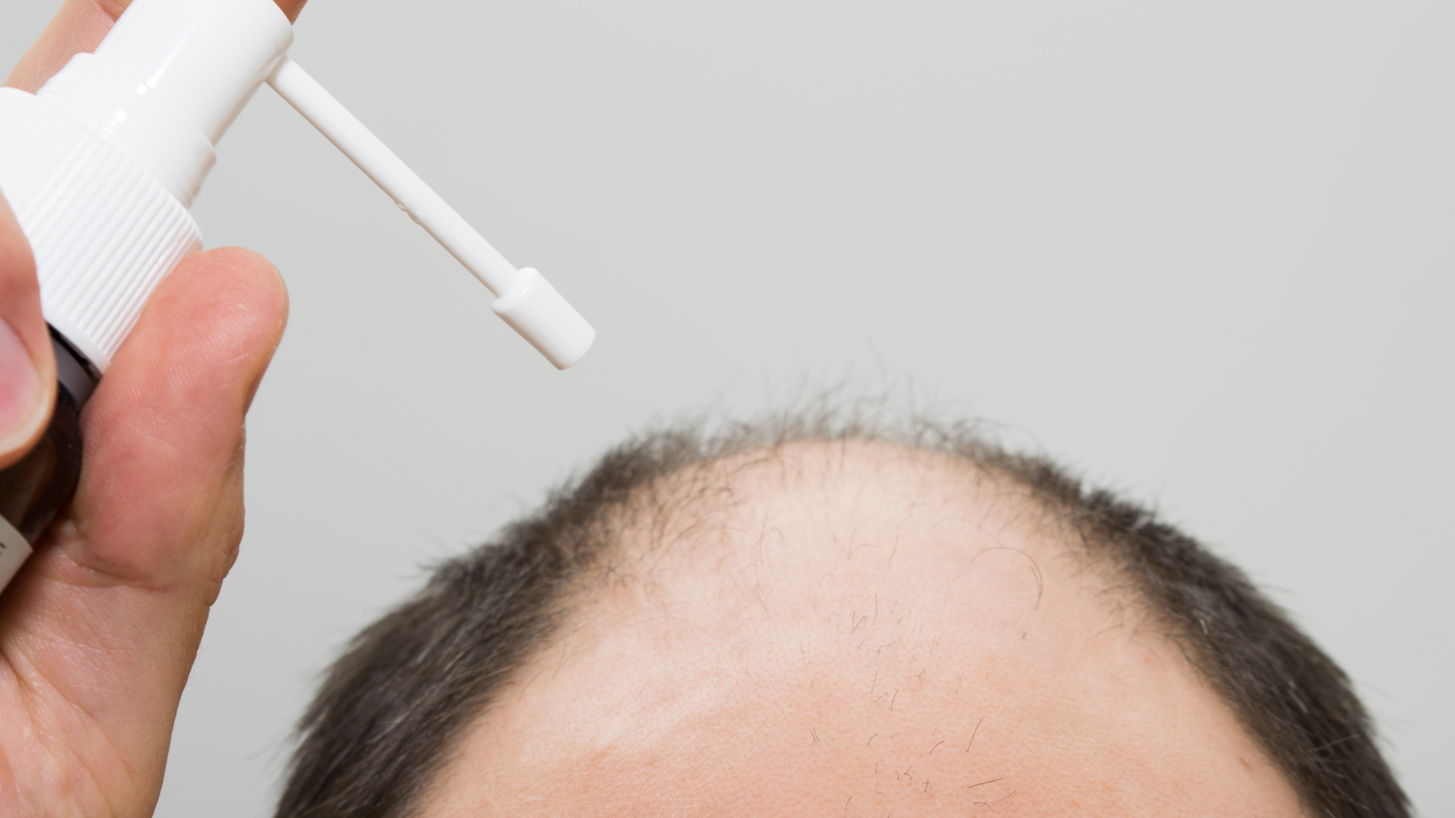 androgenetic alopecia and prostate cancer