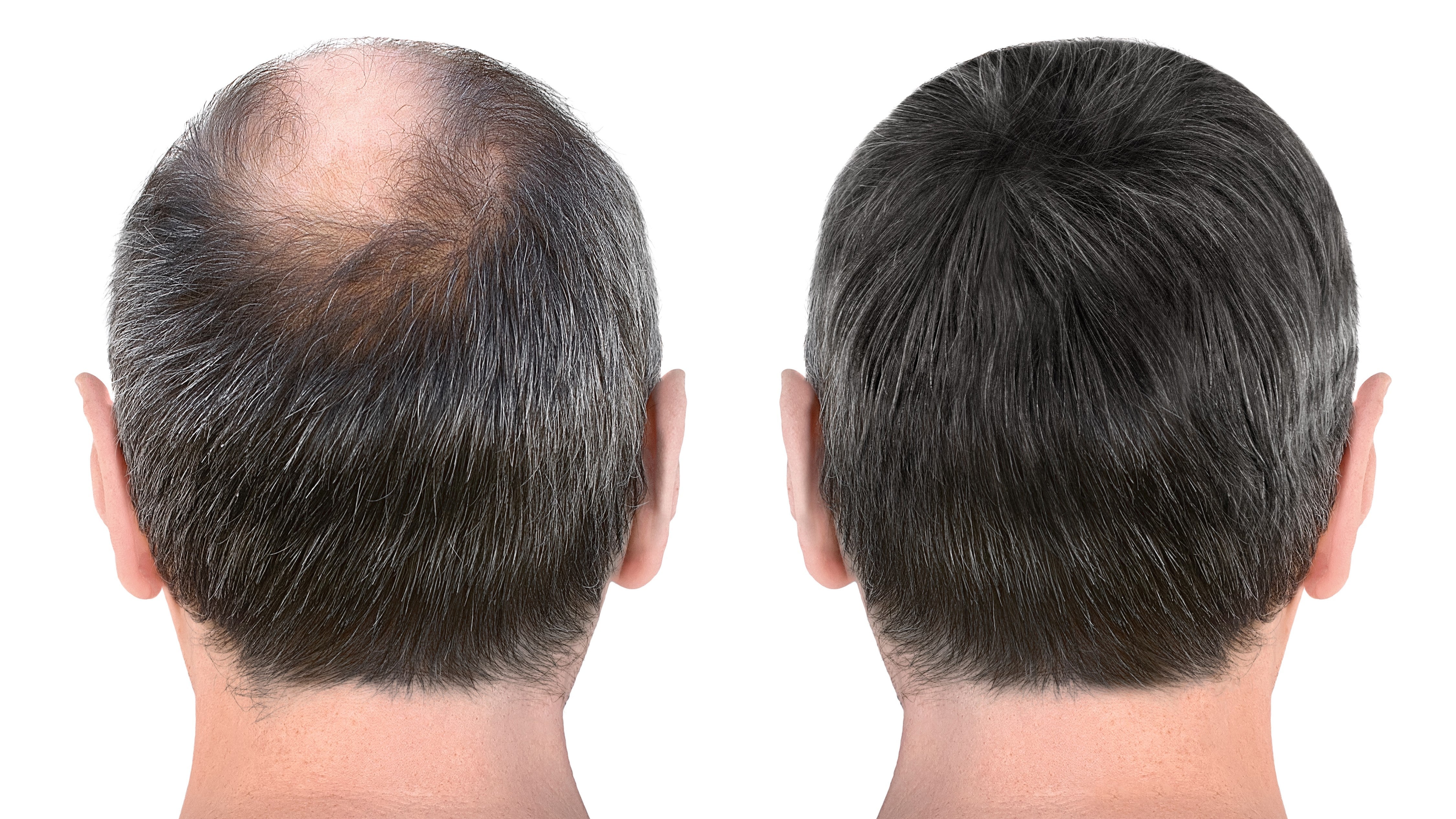 minoxidil results before and after 8 months