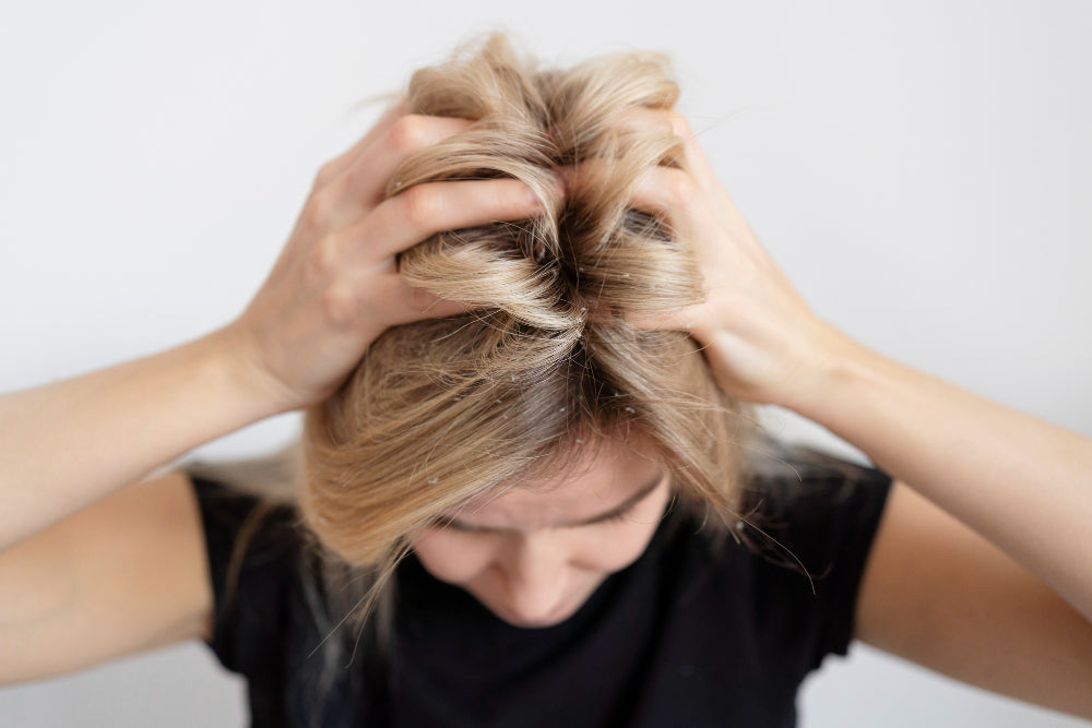 burning scalp hair loss