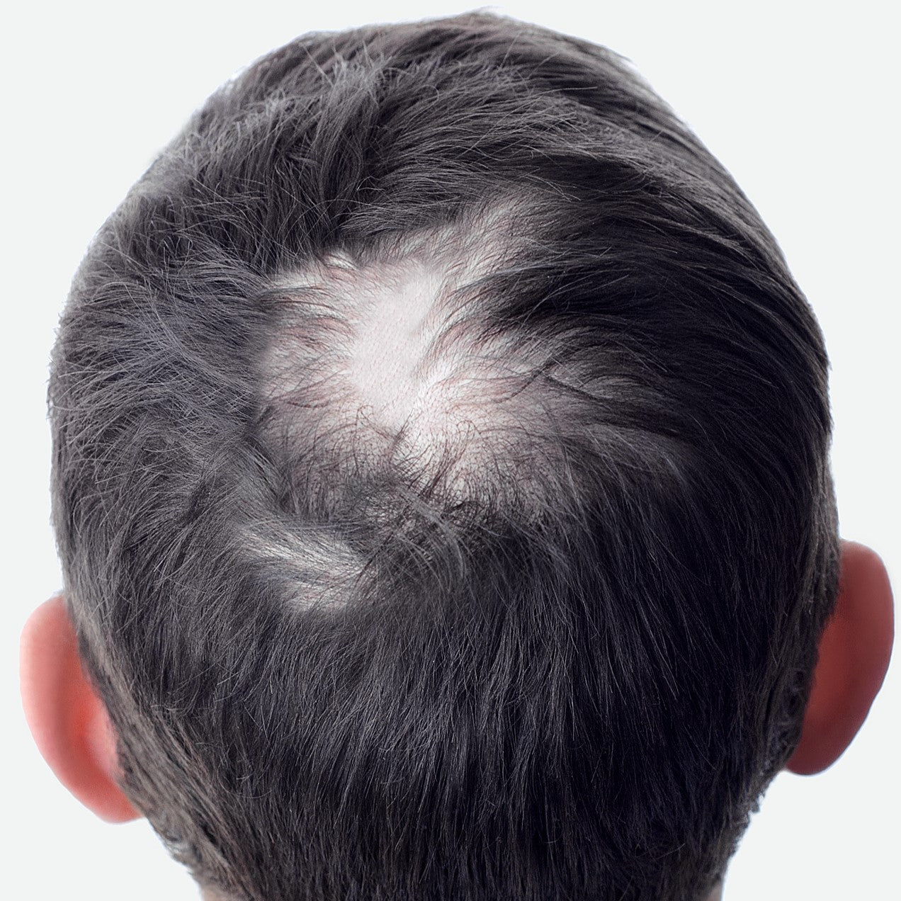crown hair thinning example