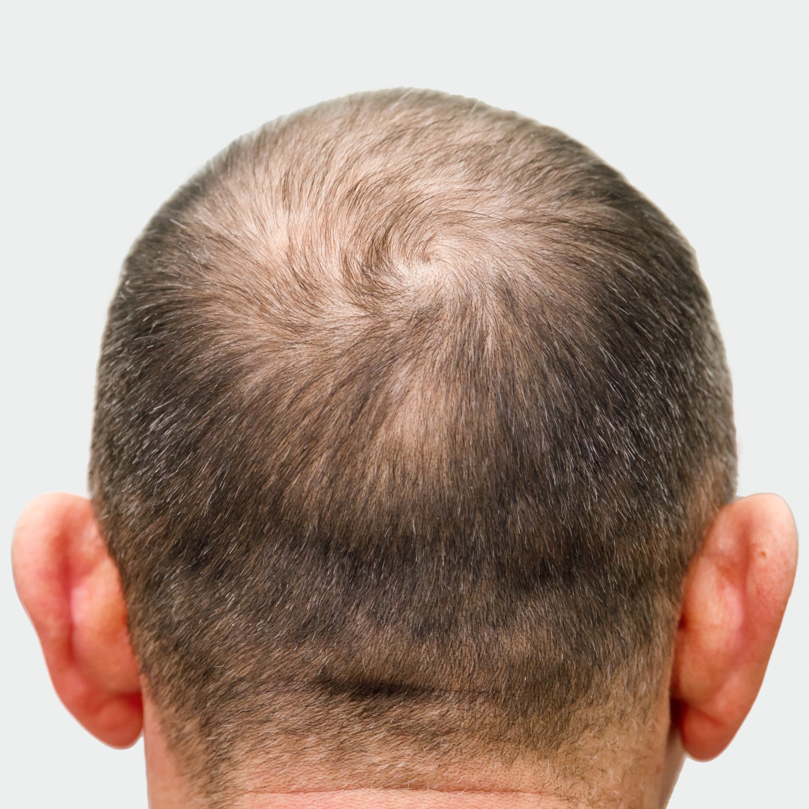 8 Hairstyles to Try When Balding | NaturallyCurly.com