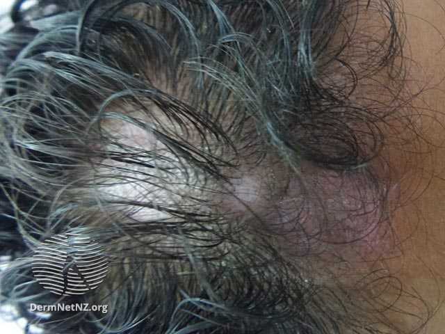 hair loss from lupus