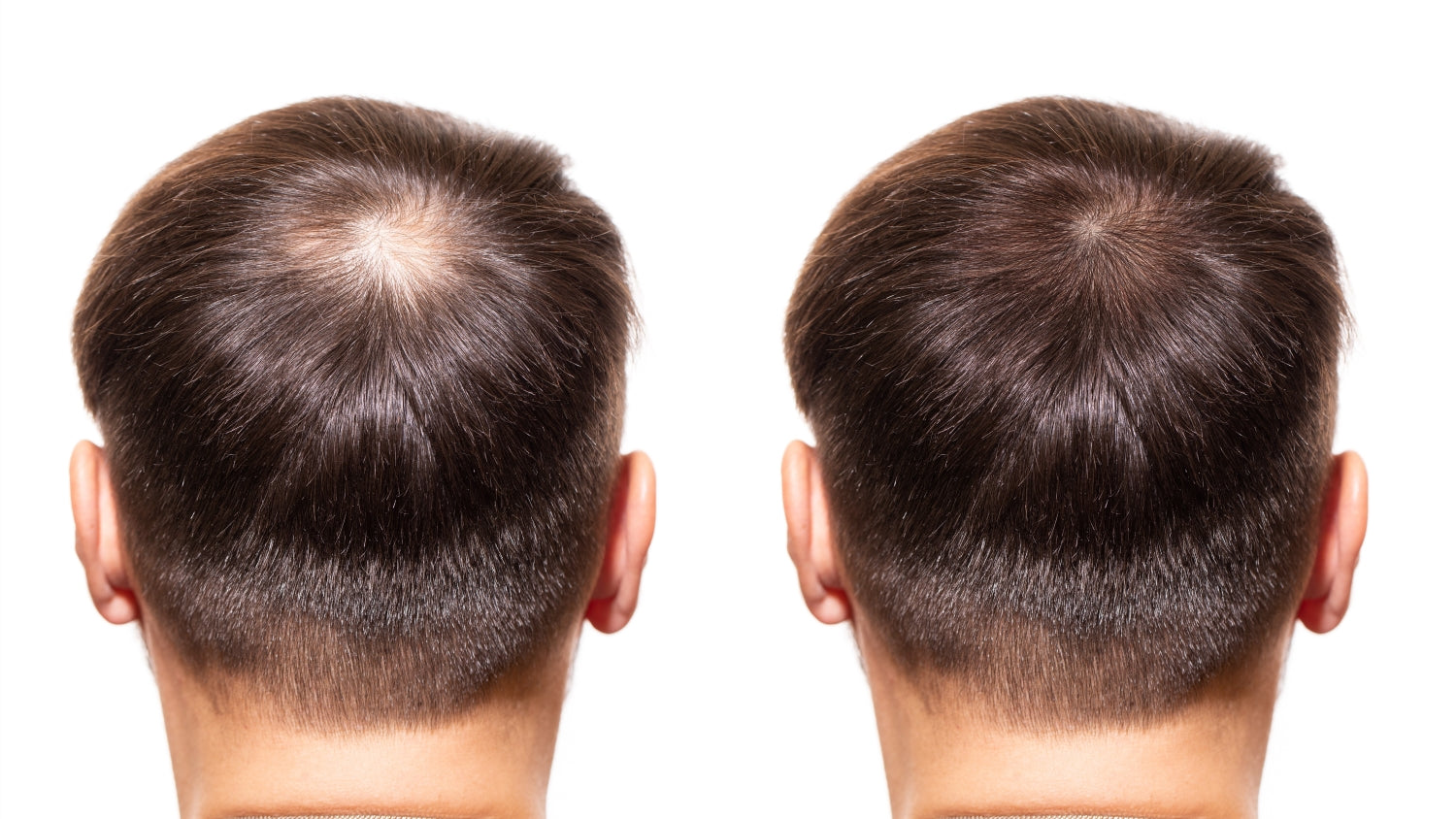 finasteride results before and after man