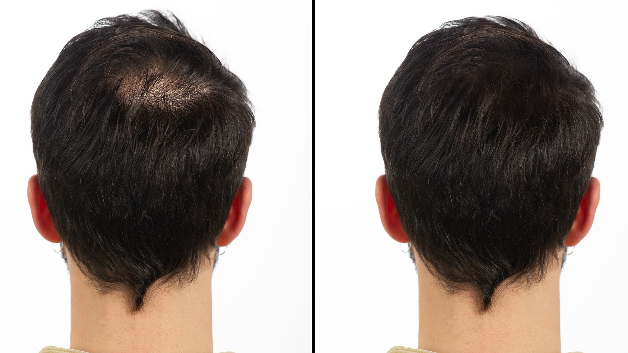 finasteride results before and after man