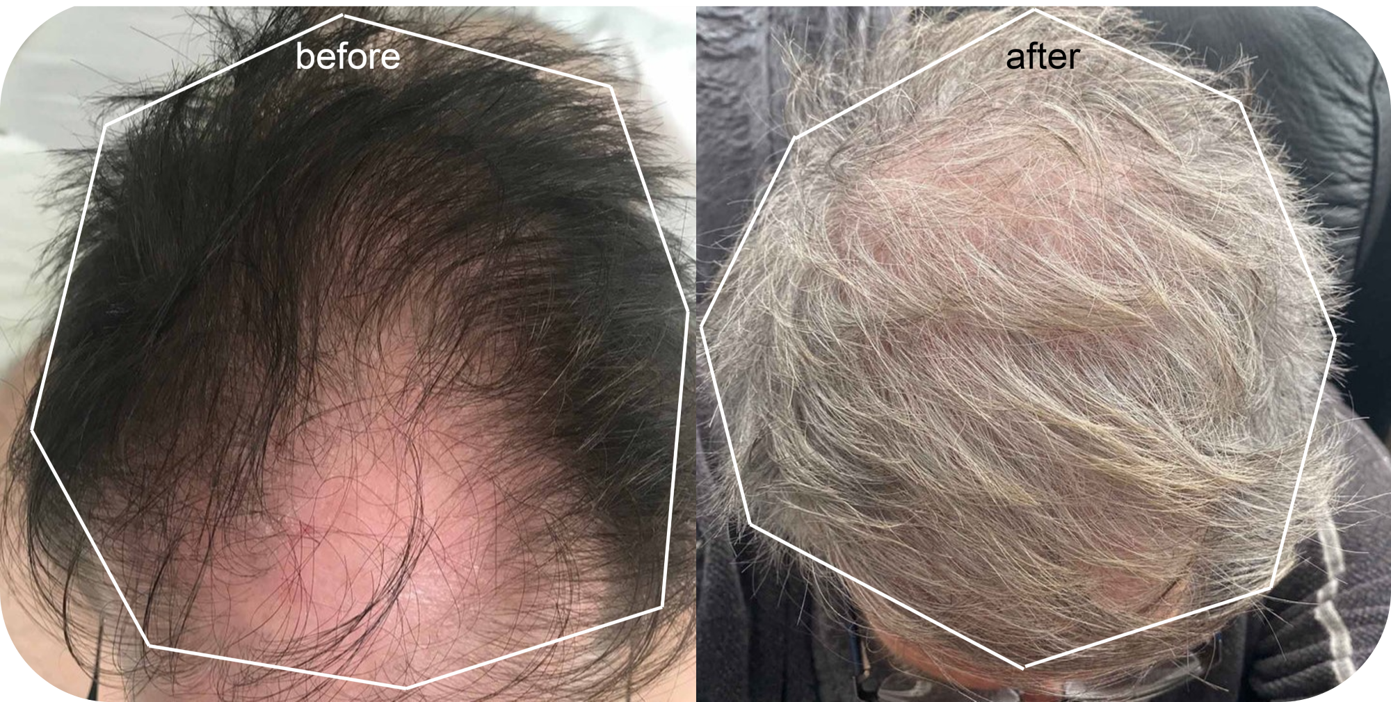 minoxidil results