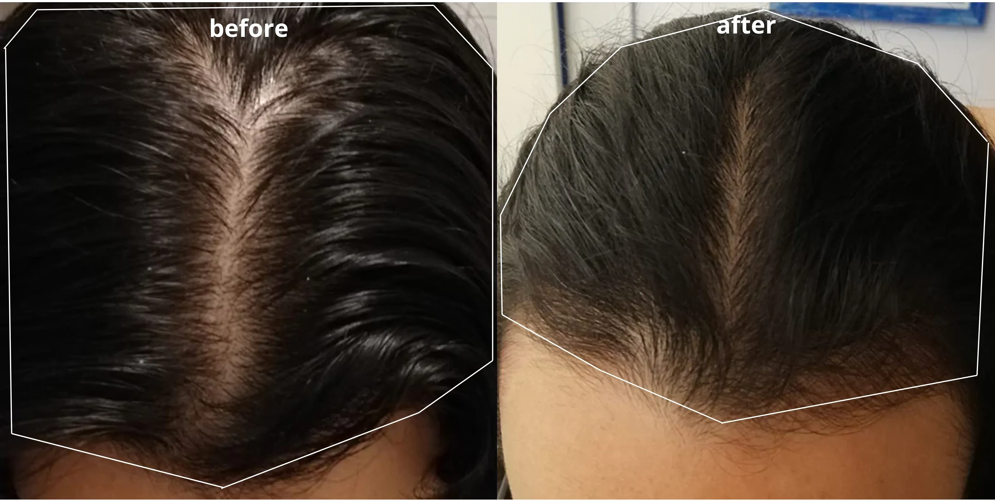 patterned hair loss, hair thinning