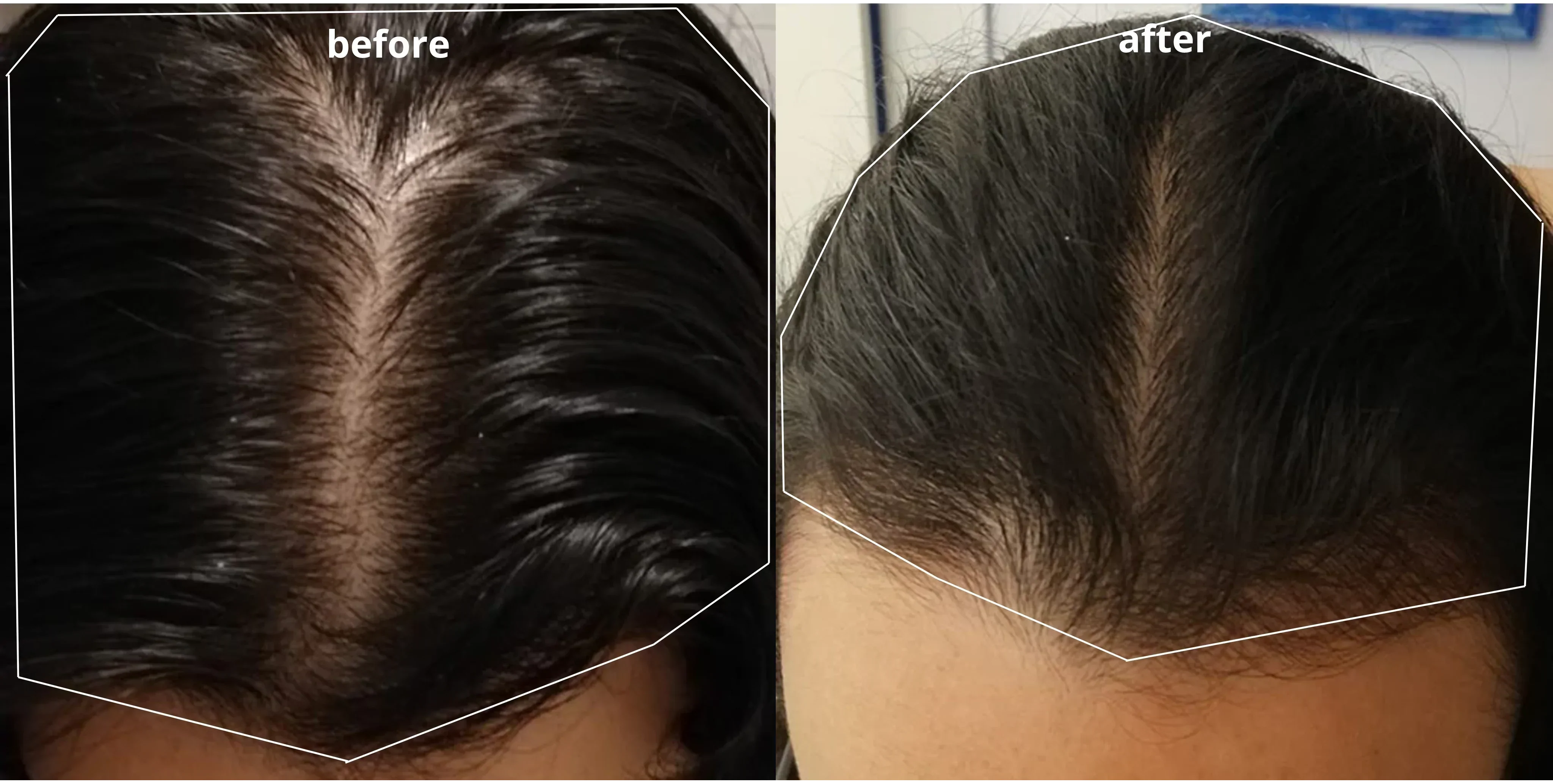 minoxidil results