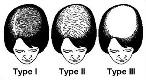 Ludwig scale of signs of balding in women