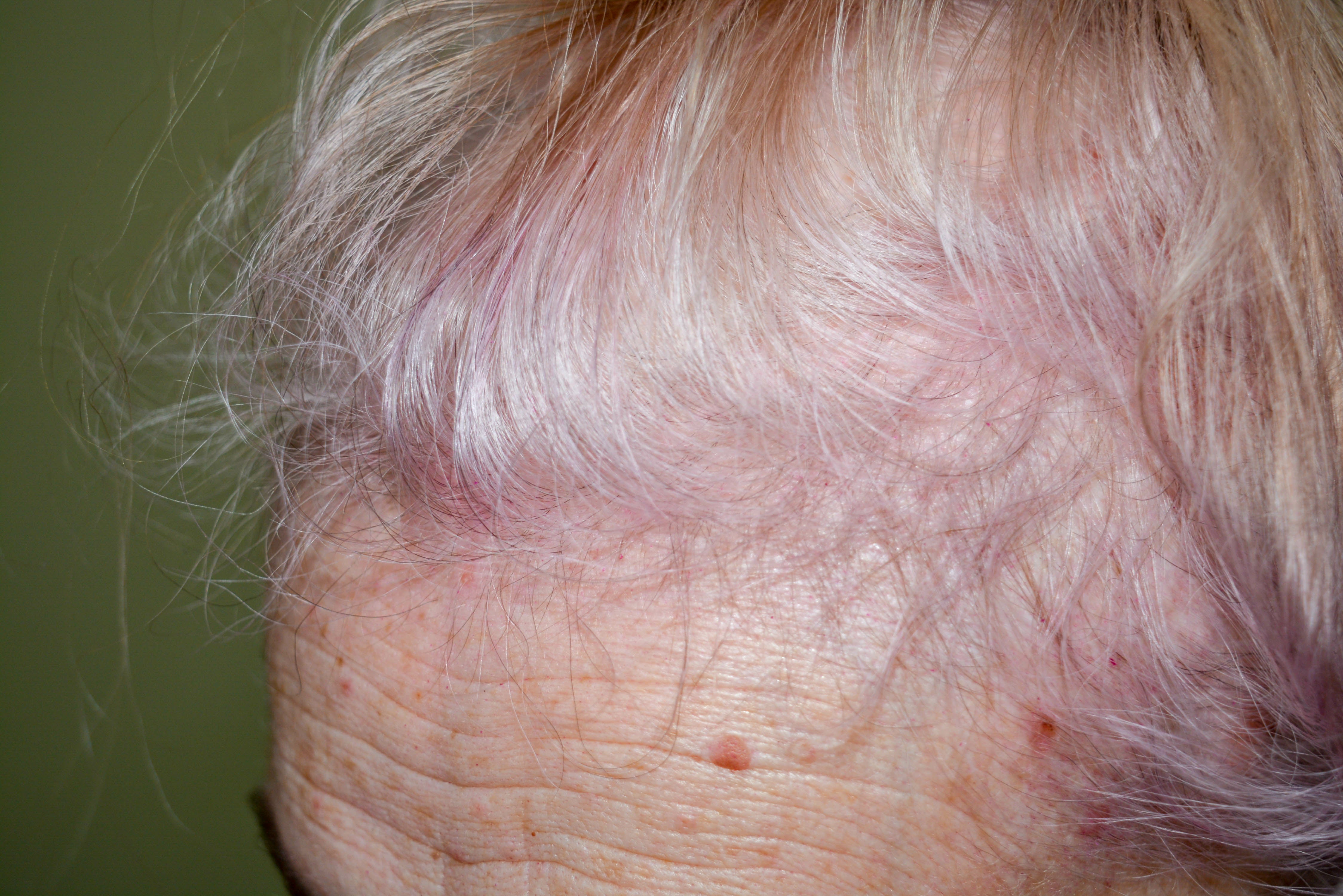 frontal lupus hair loss picture