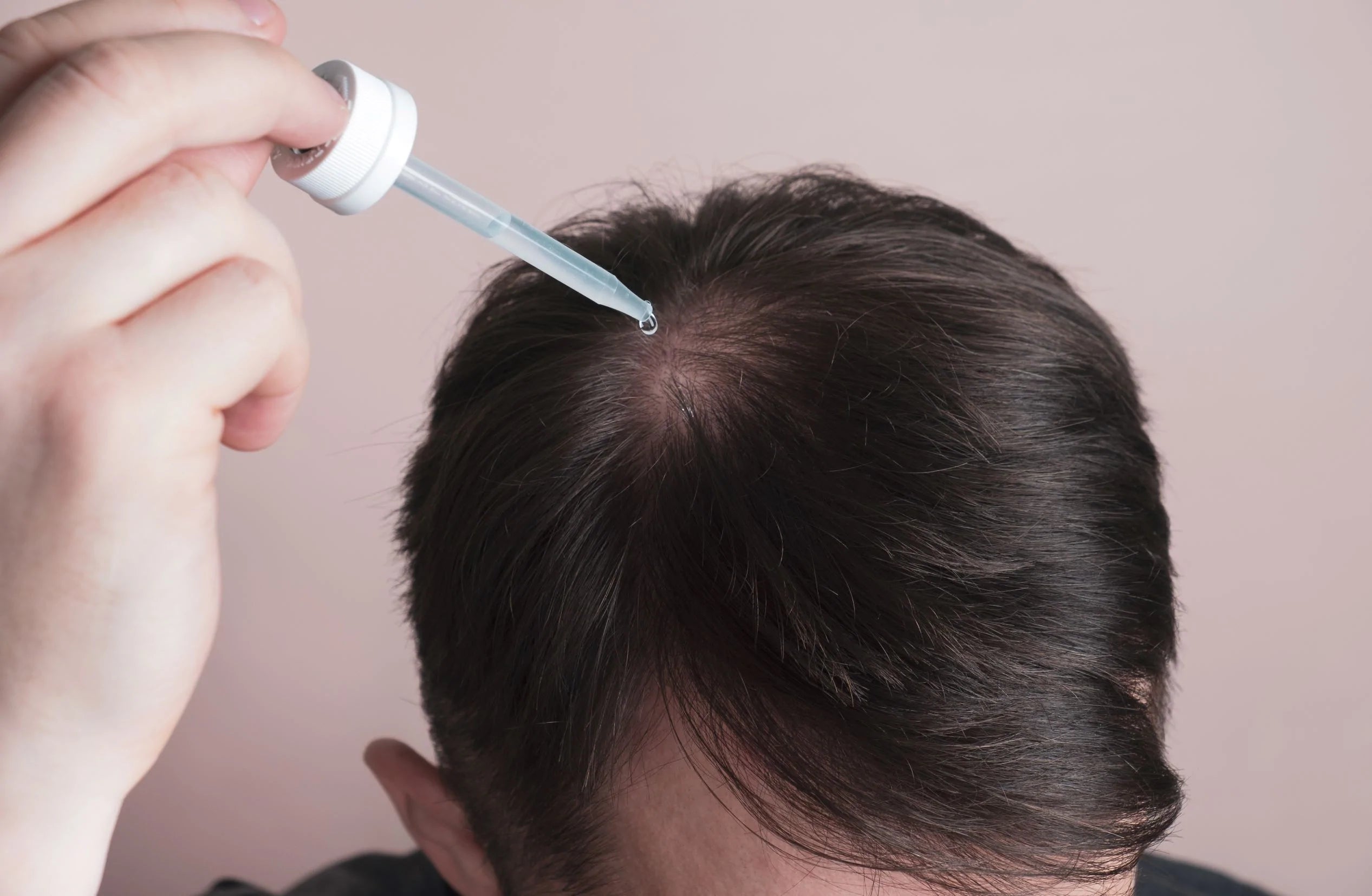 minoxidil for androgenetic alopecia