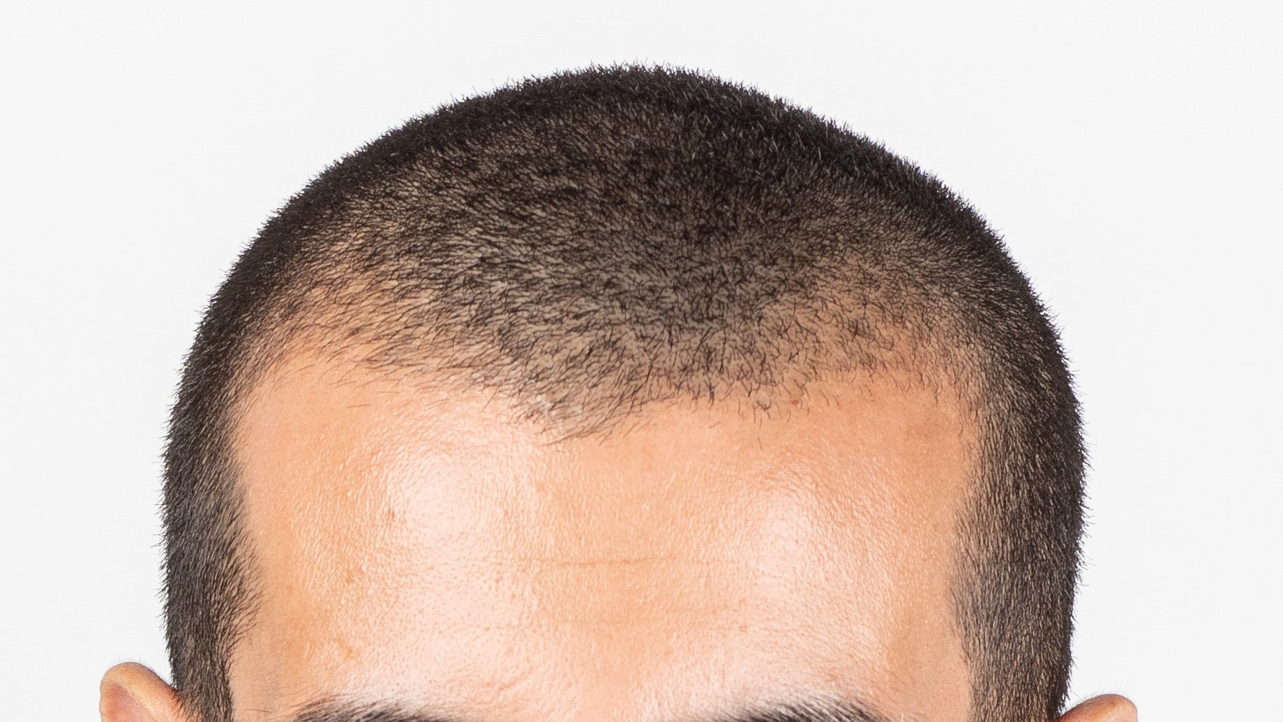 maturing hairline