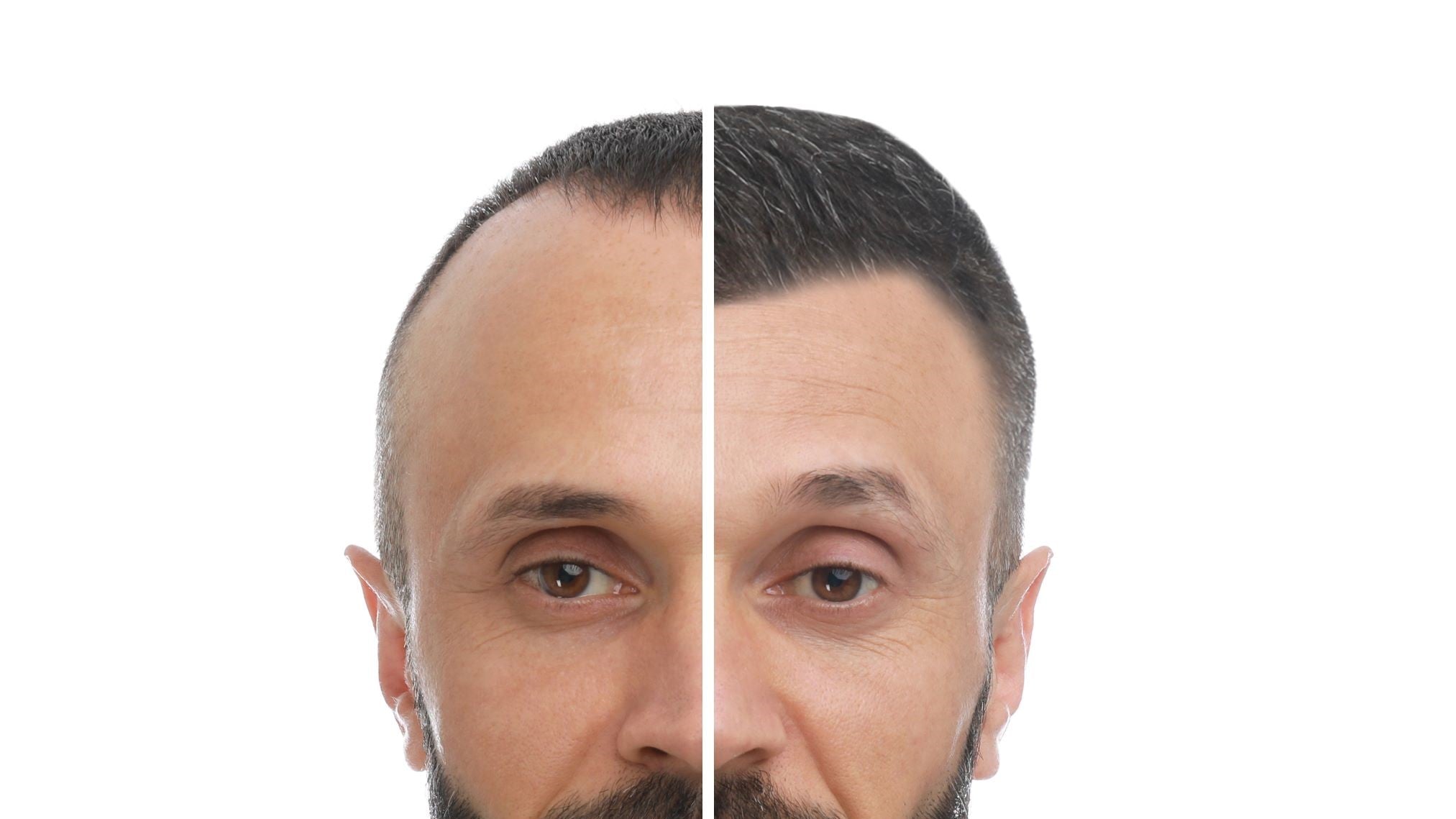 Minoxidil hairline before and after