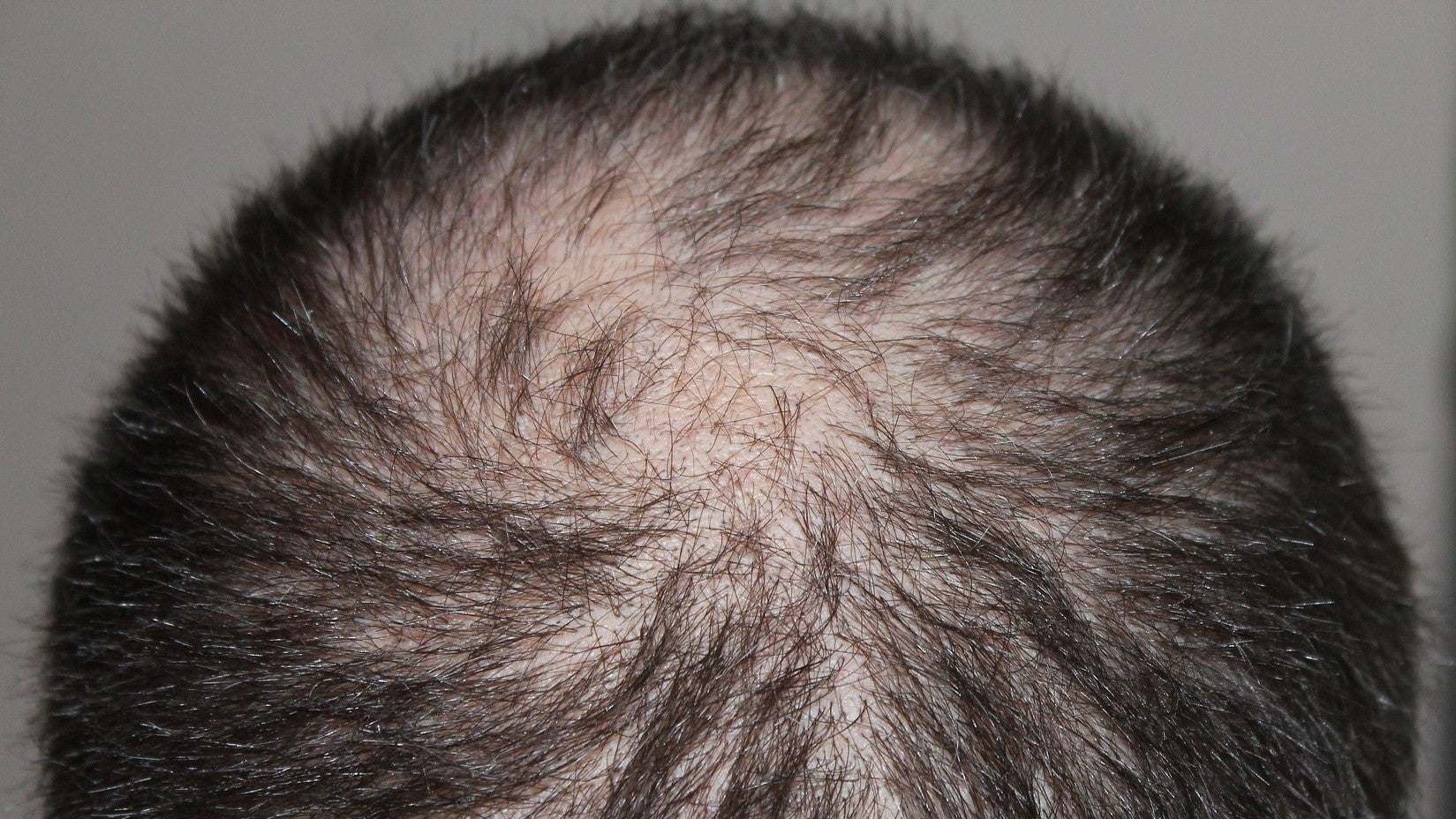 man with hair shedding from minoxidil