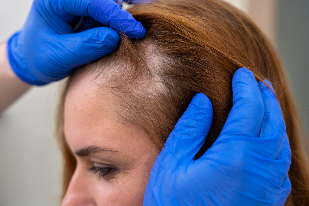 hairline lowering vs hair transplant