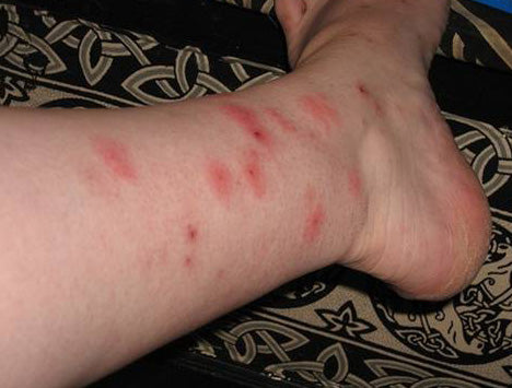 Bed Bug Rash: How to Know if your Rash is from Bedbug Bites