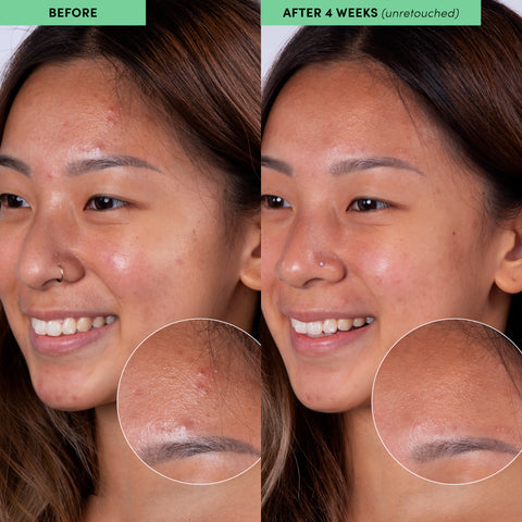 before and after image of girl with oily skin