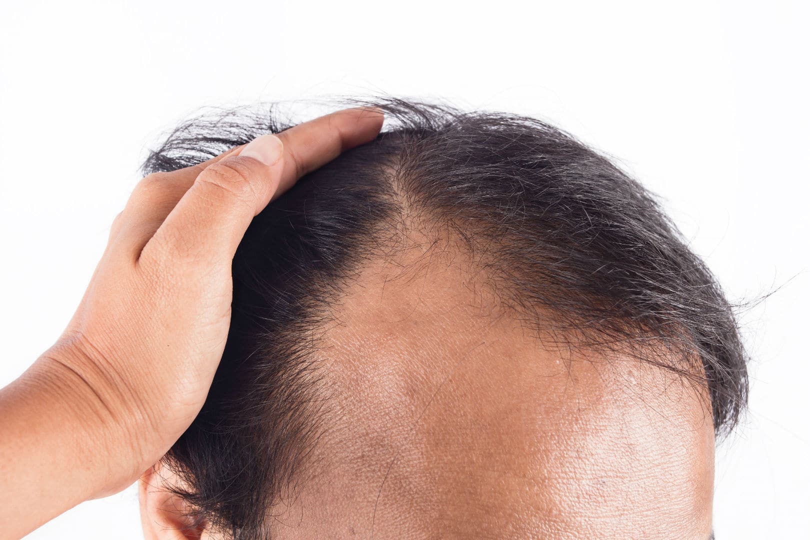 How to Stop and Prevent Receding Hairline  Receding Hairline Causes   Formen Health