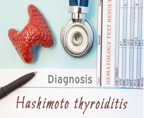 Hashimoto’s Thyroiditis 