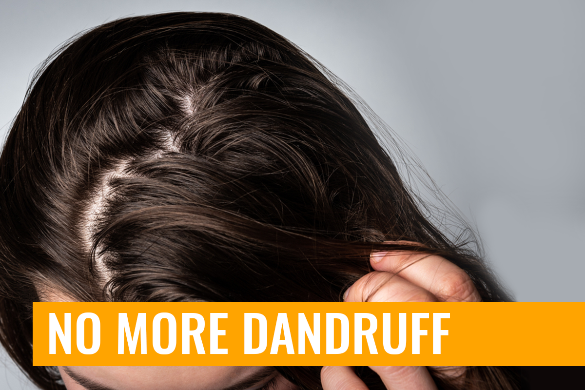 Can You Remove Dandruff in One day with Home Remedies