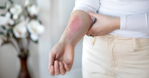 woman with symptoms of allergic contact dermatitis