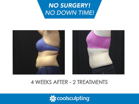 Cool Sculpting – The Skin & Vein Centre