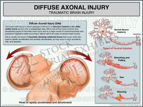 Diffuse Axonal Injury