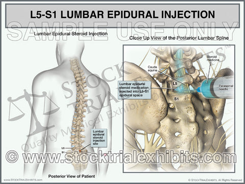 L5-S1 Epidural Injection of Lumbar Spine Medical Exhibits for Settlement and Trial Presentation of Personal Injury Cases 