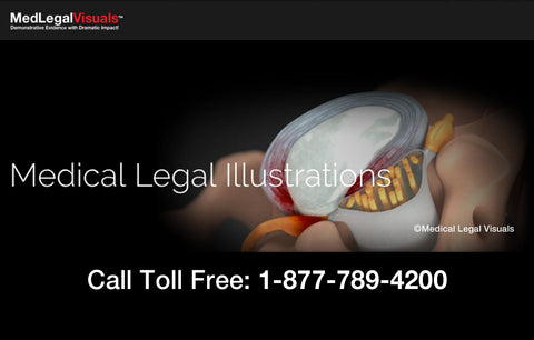 Medical Legal Illustration