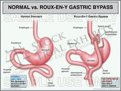 Normal Stomach vs Roux En Y Gastric Bypass